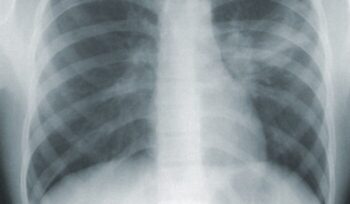 Chest x-ray