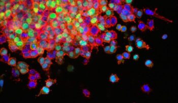 Lung cancer metastasis